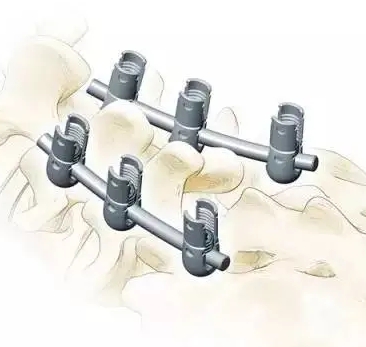 美敦力脊柱内固定系统