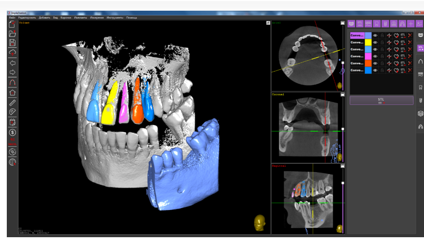 MyDentViewer 口腔医学影像处理软件