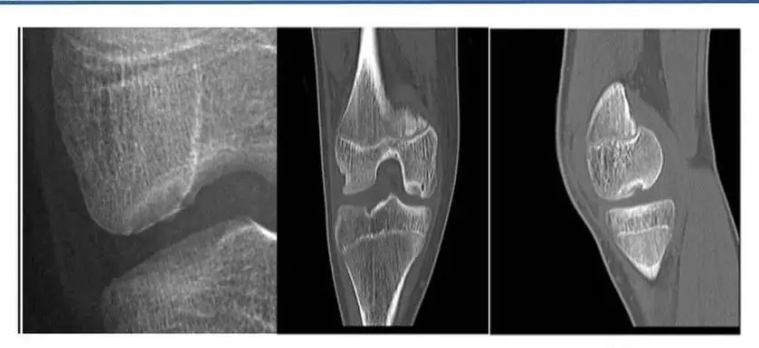 uIGS-Joint 髋膝关节医学影像处理软件