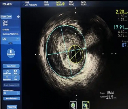 into ivus 血管内超声影像处理软件