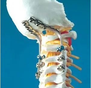 强生脊柱内固定系统组件