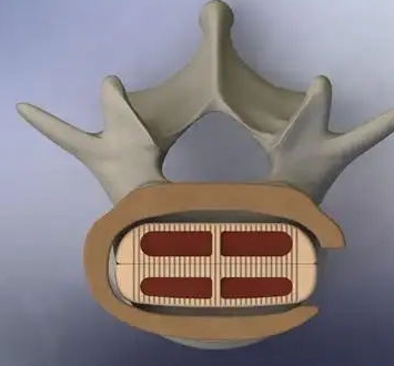 椎体融合器博益宁