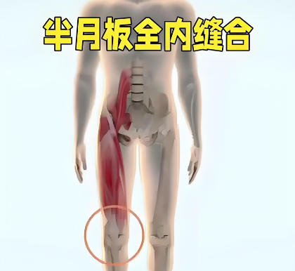 全缝线半月板缝合系统 厂家